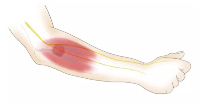 TENNIS ELBOW
