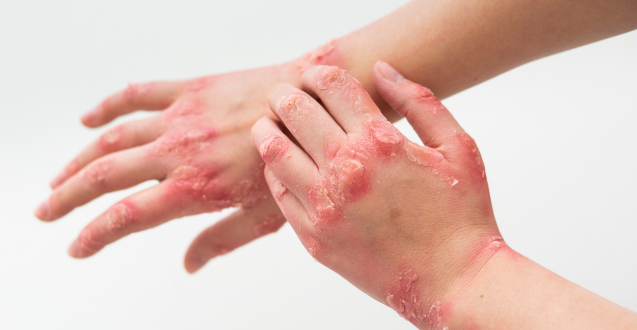 BEAT PSORIASIS NATURALLY – DISCOVER NATURAL WAY TO SOOTHE YOUR SKIN